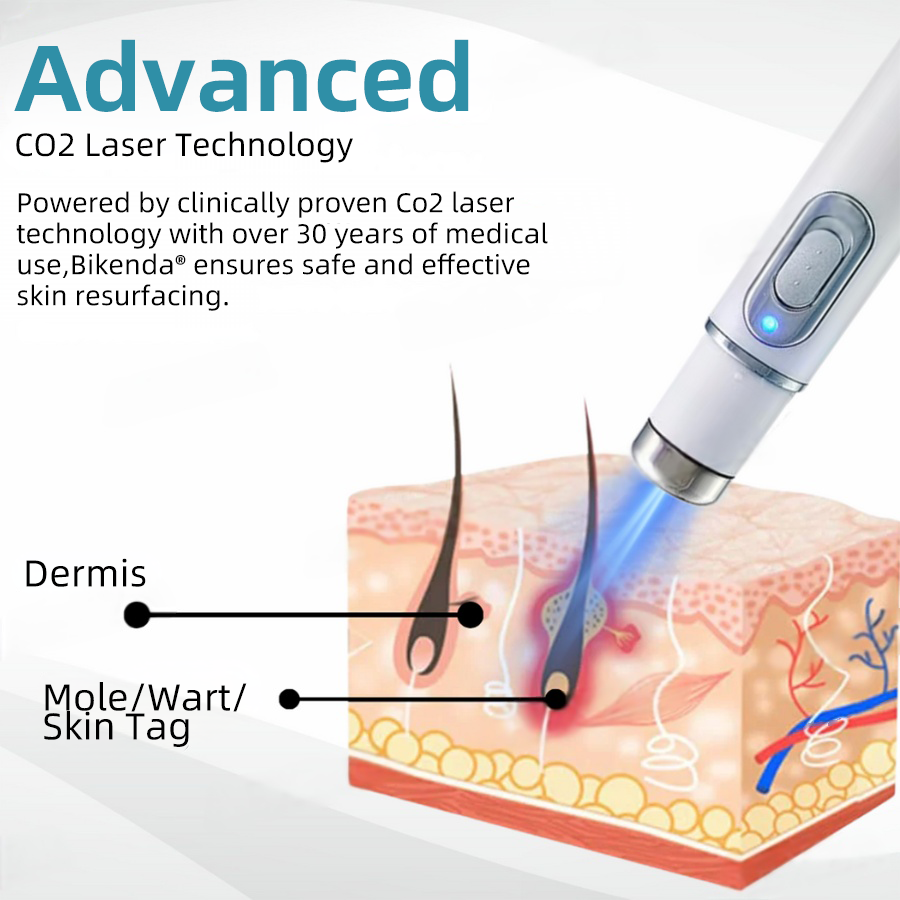 DermaLase™ | Nicht-invasive Maulwurf- und Warzenentfernung Laser Pen Promax