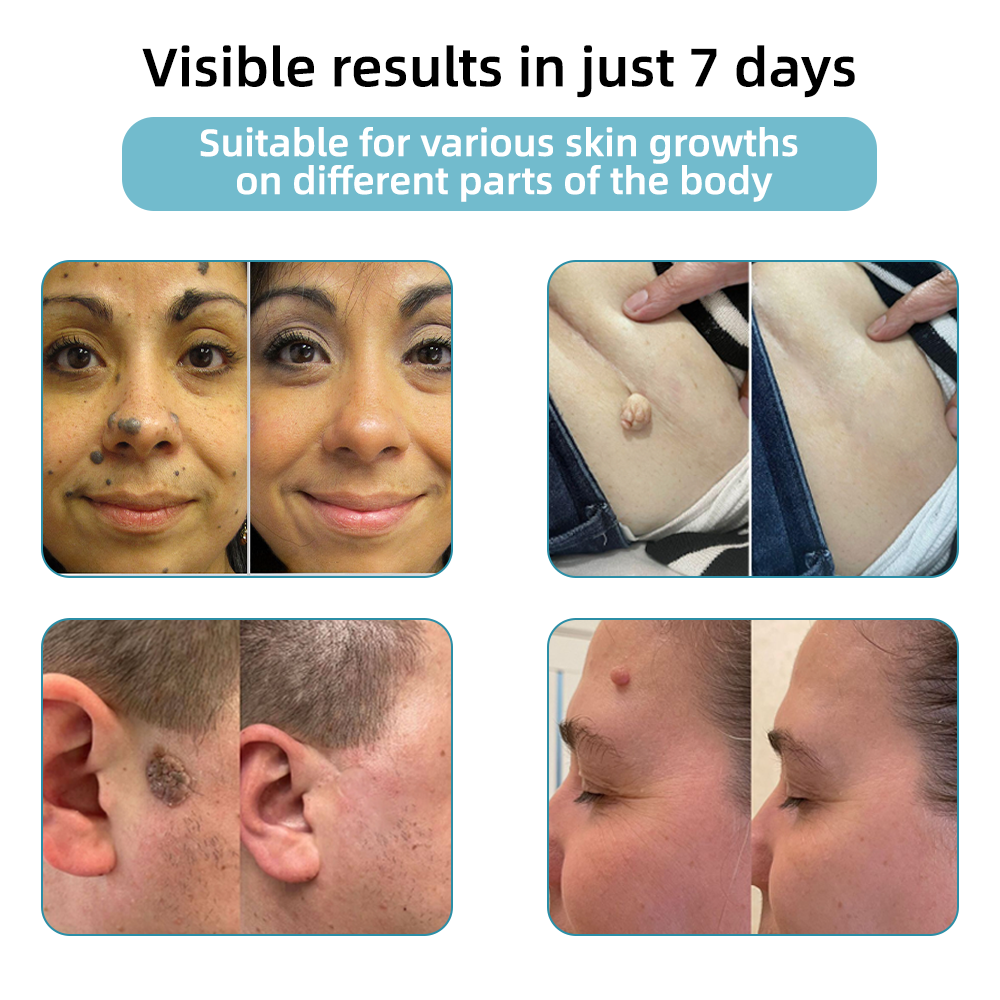 DermaLase™ | Nicht-invasive Maulwurf- und Warzenentfernung Laser Pen Promax
