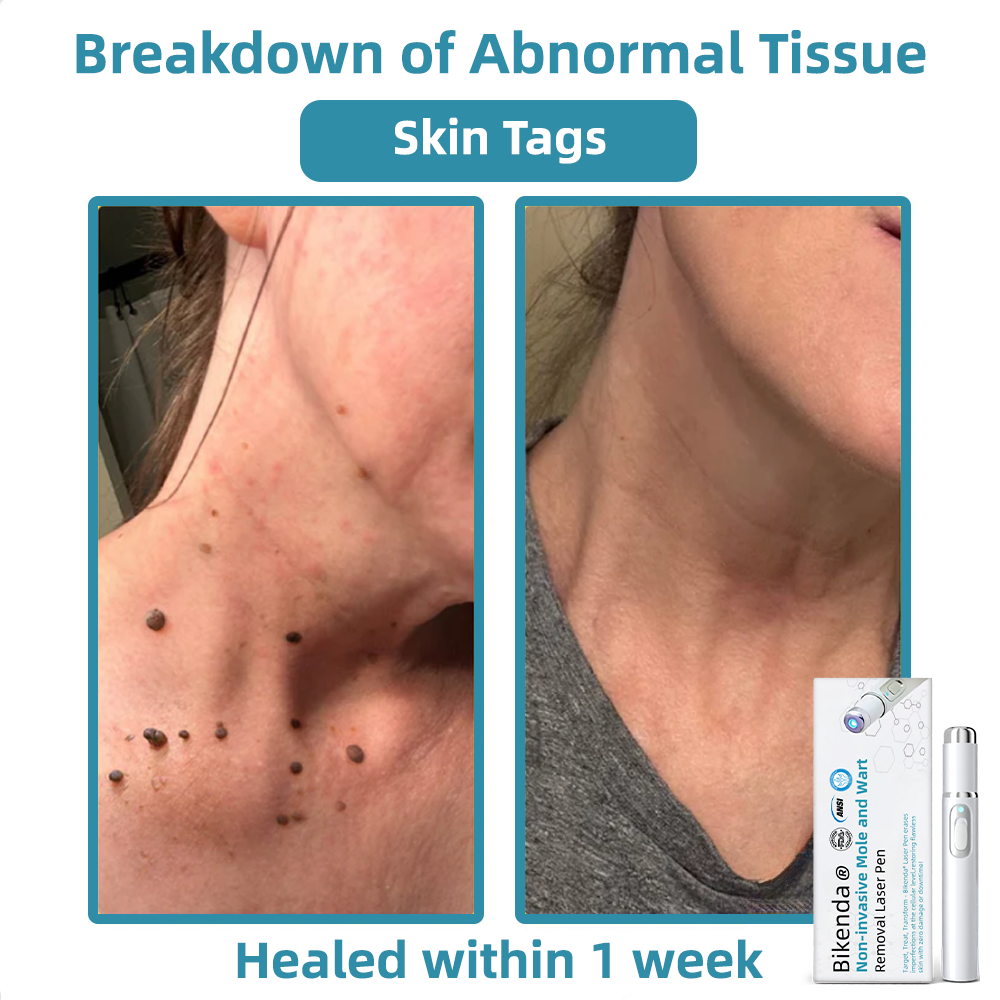 DermaLase™ | Nicht-invasive Maulwurf- und Warzenentfernung Laser Pen Promax