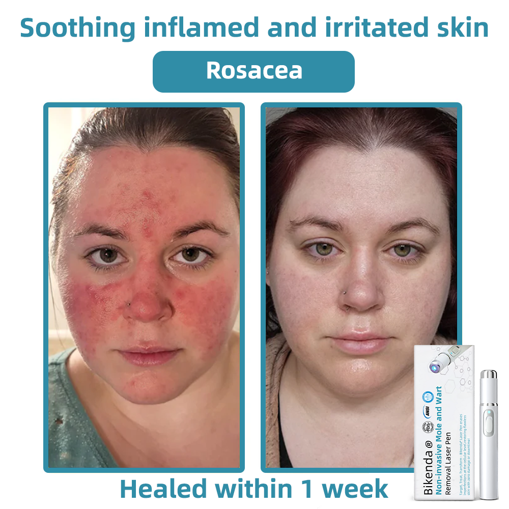 DermaLase™ | Nicht-invasive Maulwurf- und Warzenentfernung Laser Pen Promax