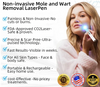 DermaLase™ | Nicht-invasive Maulwurf- und Warzenentfernung Laser Pen Promax