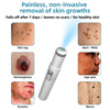 DermaLase™ | Nicht-invasive Maulwurf- und Warzenentfernung Laser Pen Promax