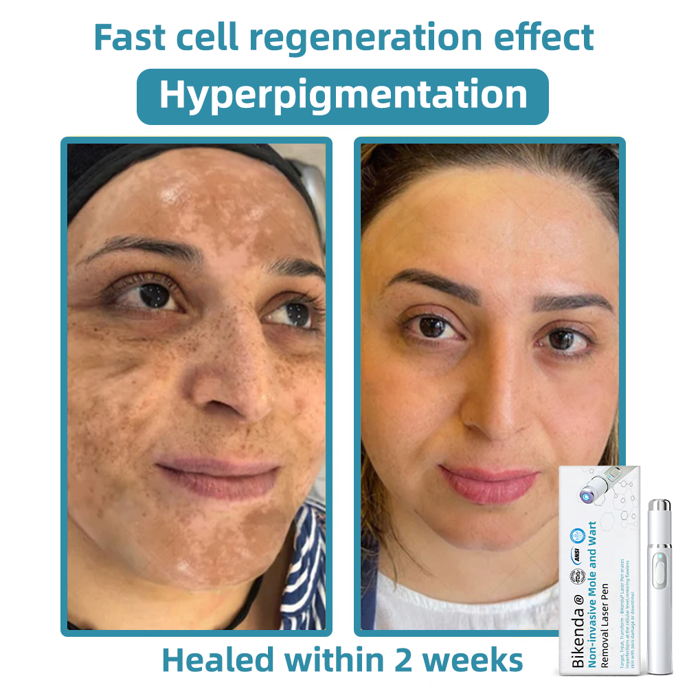 DermaLase™ | Nicht-invasive Maulwurf- und Warzenentfernung Laser Pen Promax