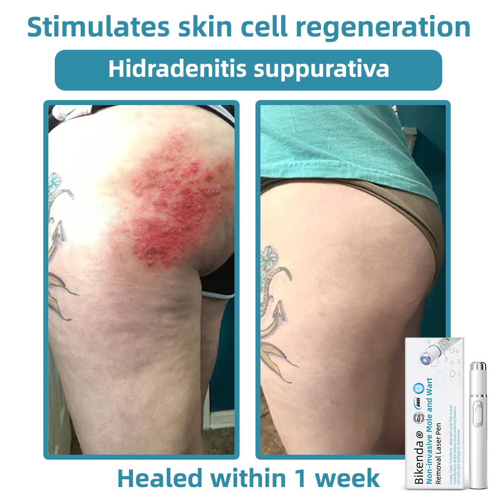 DermaLase™ | Nicht-invasive Maulwurf- und Warzenentfernung Laser Pen Promax