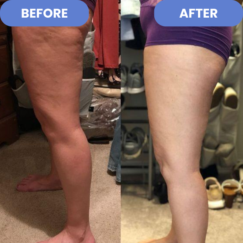 CelluSculpt™ – Anti-Cellulite-Massagegerät