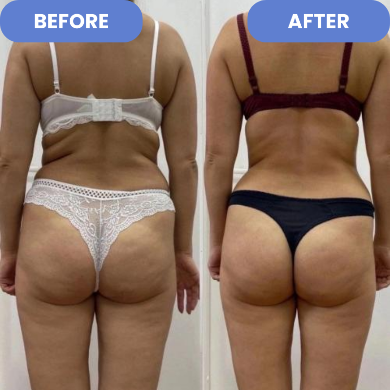 CelluSculpt™ – Anti-Cellulite-Massagegerät